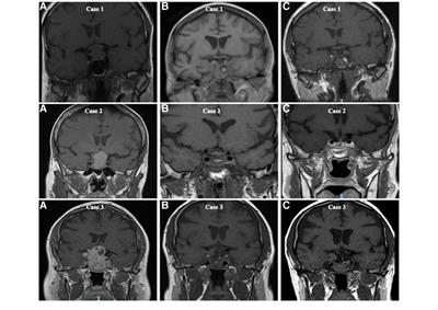 Non-functioning pituitary macroadenoma following surgery: long-term outcomes and development of an optimal follow-up strategy